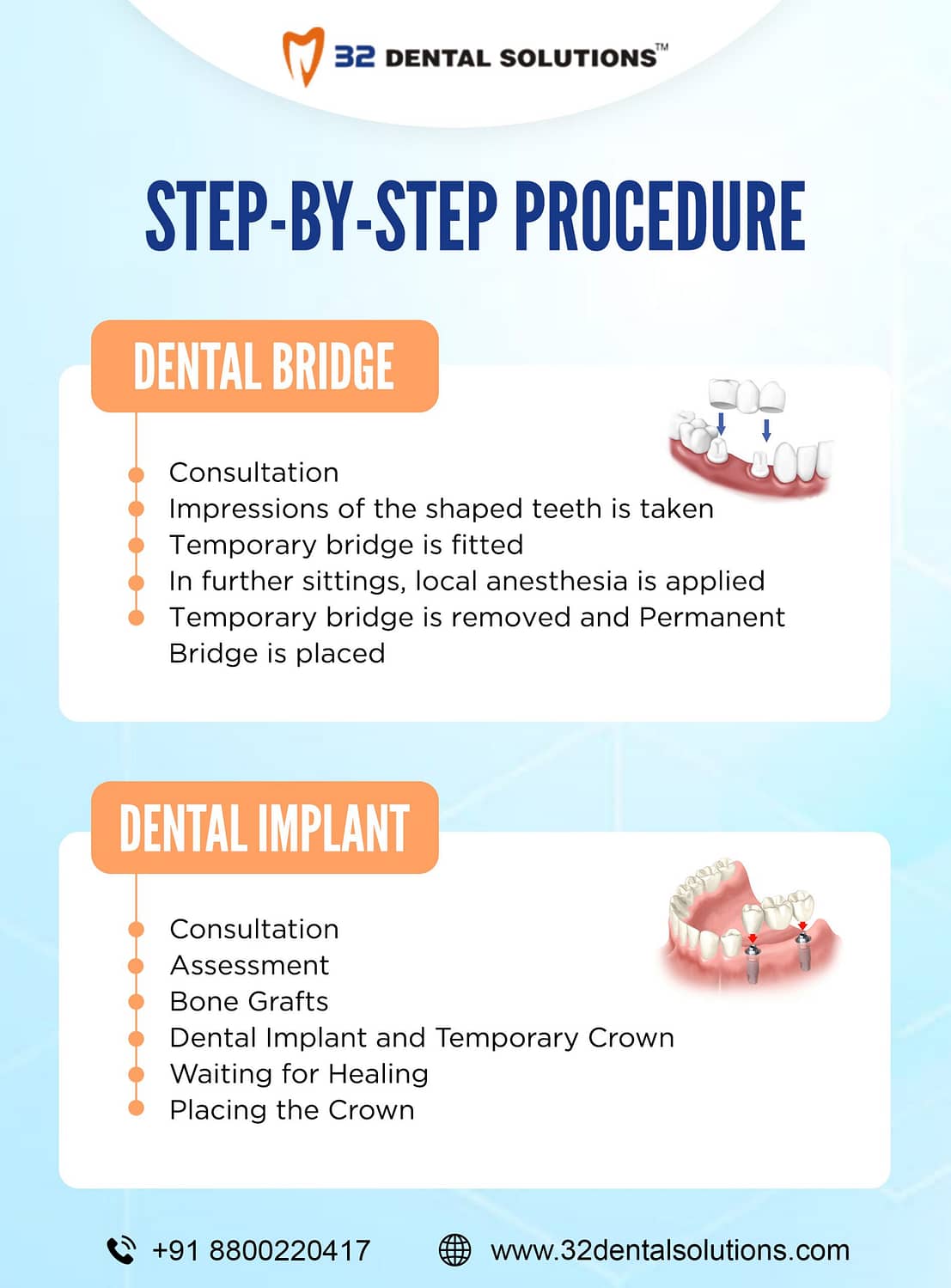 Procedure for Dental Bridge and Dental Implant